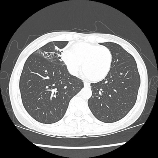 Viêm phổi do Mycobacterium Avium (Pulmonary Mycobacterium avium complex infection - MAC)