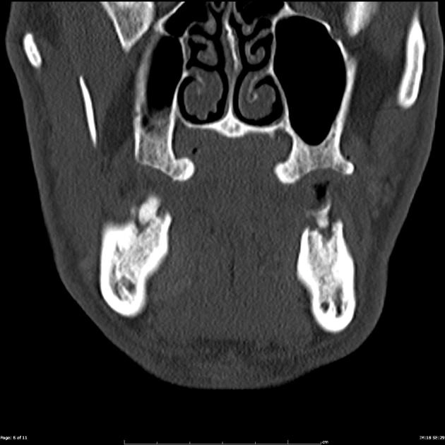 Lồi xương hàm trên (Maxillary torus)