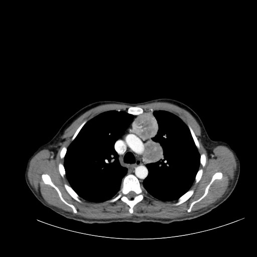 U Carcinoid/nội tiết thần kinh tuyến ức - Carcinoid/neuroendocrine tumors of the thymus 