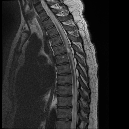 Nang thượng bì cột sống (Spinal epidermoid cyst)