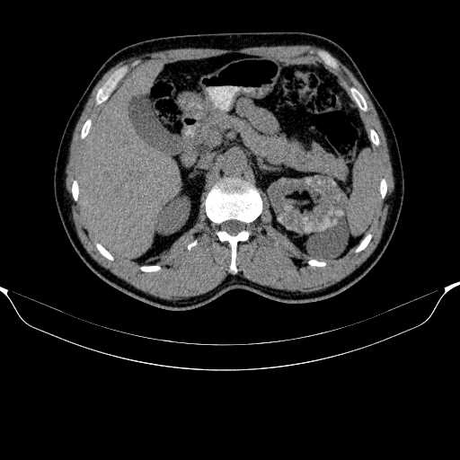 Bệnh thận dạng nang khu trú (Localized cystic renal disease - LCRD)