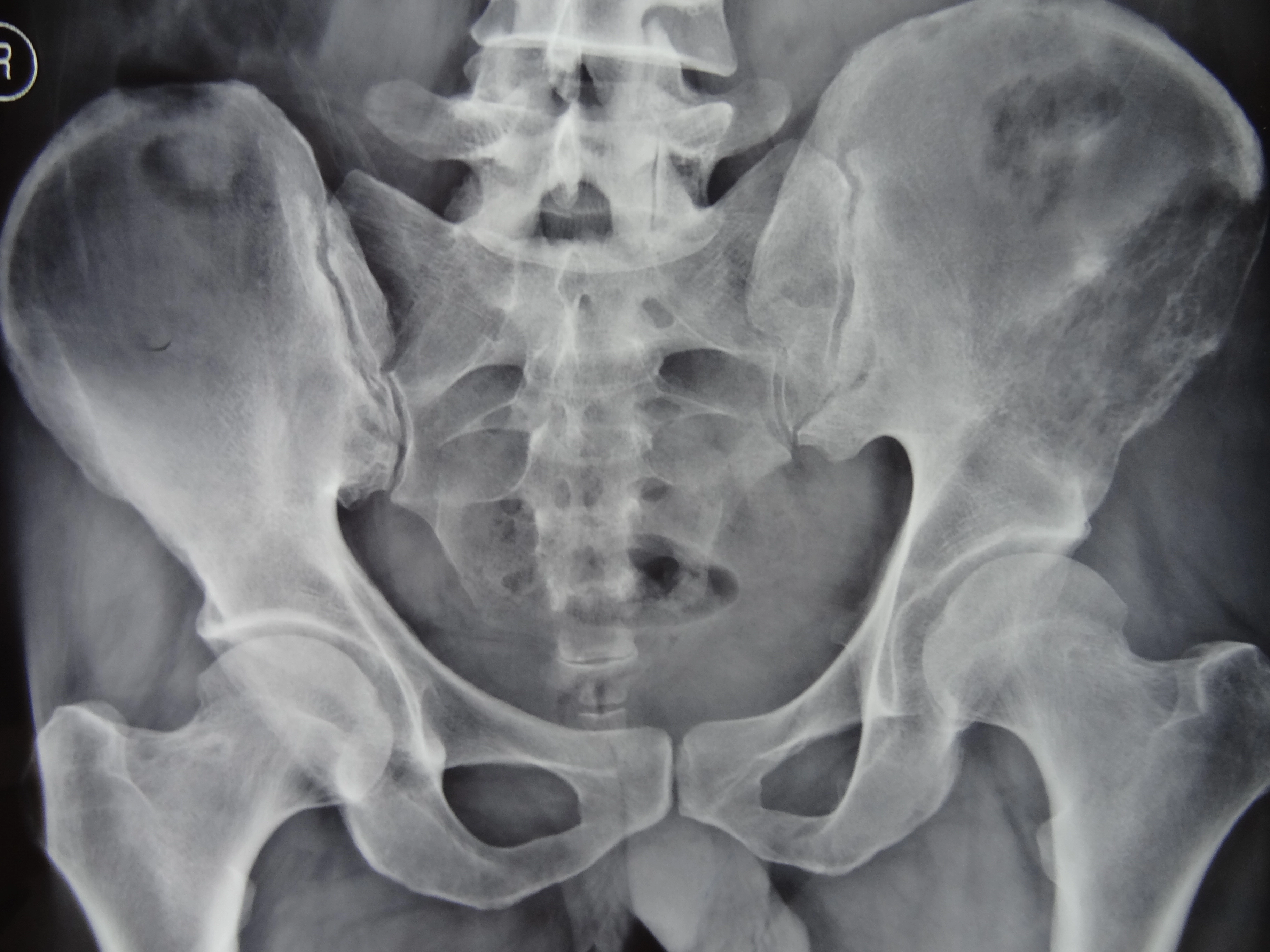 Di căn tiêu xương (Lytic bone metastases)