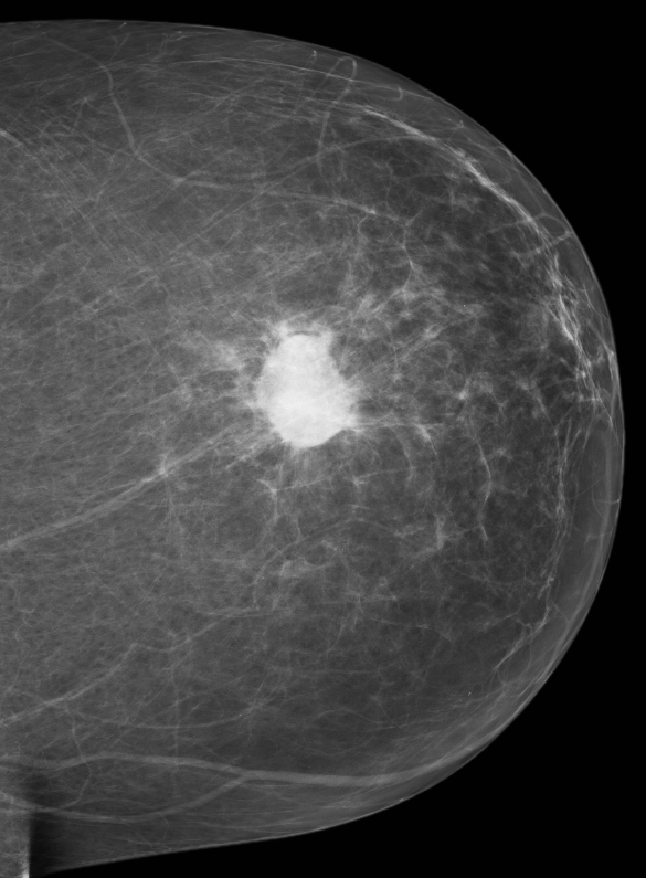 Ung thư biểu mô tuyến vú dị sản (Metaplastic breast carcinoma - MBC)