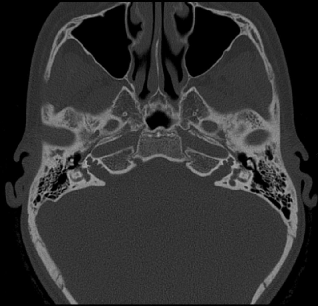 Phân chia không hoàn toàn ốc tai loại III (Cochlear incomplete partition type III)
