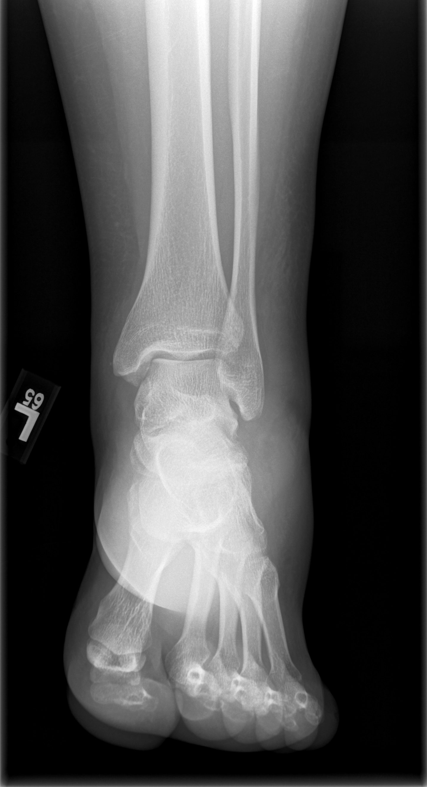 Tổn thương sụn và xương dưới sên (Osteochondral lesion of the talus - OLT)