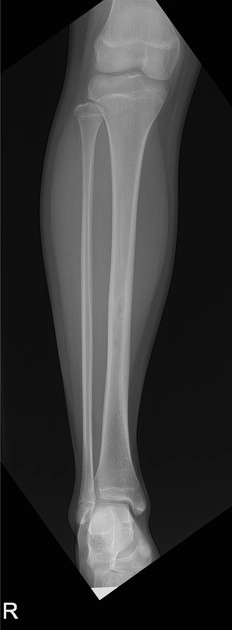 Loạn sản xơ tạo xương (Osteofibrous dysplasia)