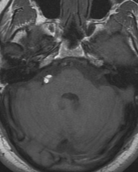 U mỡ góc cầu tiểu não (Cerebellopontine angle lipoma)