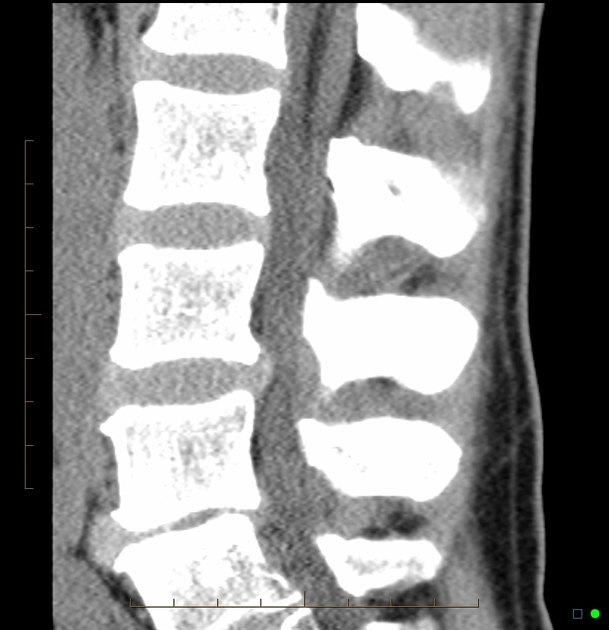 U mỡ dây tận (Lipoma of the filum terminale)