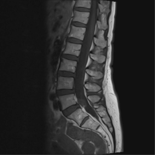 Nang khớp liên mấu (Spinal synovial cyst)
