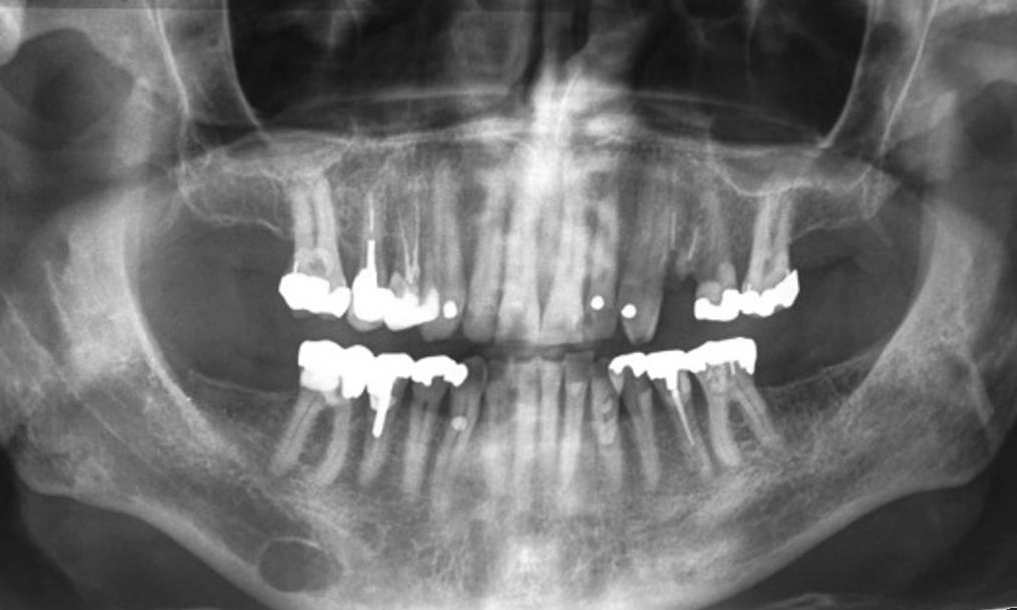 Hốc xương Stafne (Stafne bone cavity)