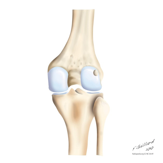 Gãy bong phức hợp dây chằng cung (Dấu hiệu Arcuate)