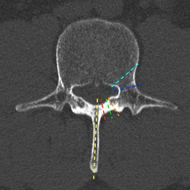 Bất thường hợp nhất cung sau (Posterior vertebral fusion anomalies)