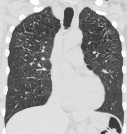 Bệnh Erdheim-Chester (Erdheim-Chester Disease - ECD) 