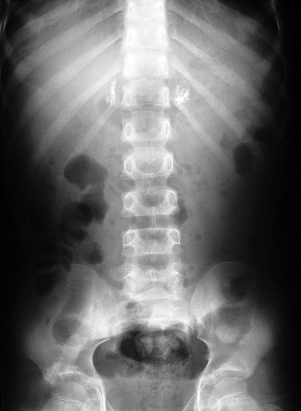 Lao tuyến thượng thận (Adrenal tuberculosis)