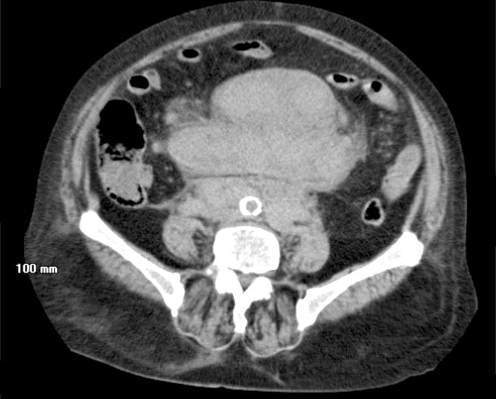 Lymphoma mạc treo (mesenteric lymphoma)
