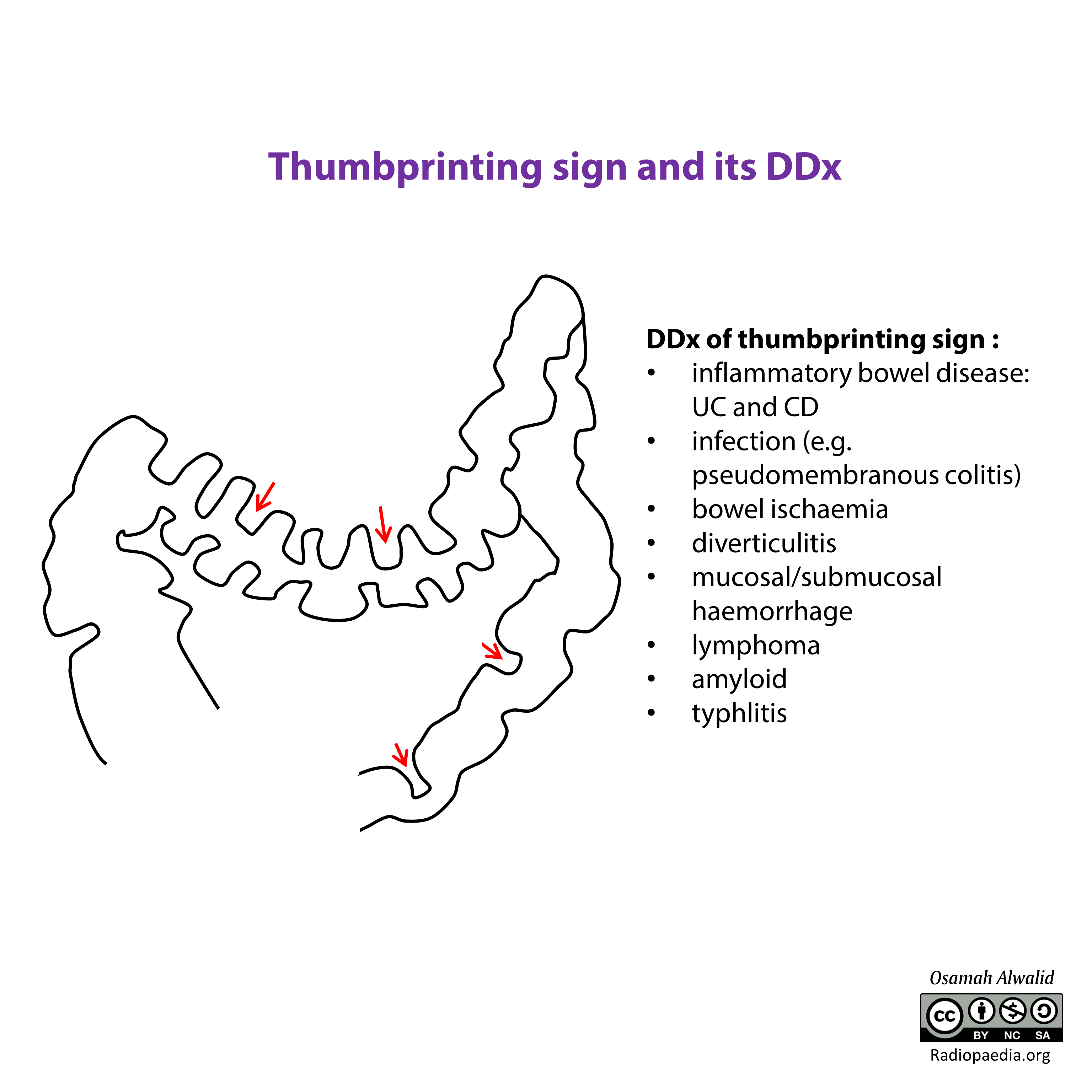Dấu hiệu ấn ngón tay (Thumbprinting sign)