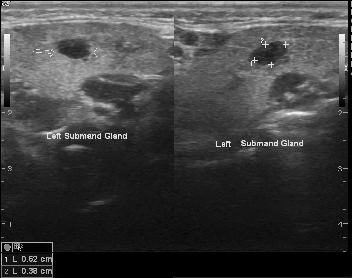Oncocytoma tuyến nước bọt (Oncocytoma of the salivary glands)
