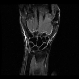 Bệnh lý gân duỗi cổ tay trụ (Extensor Carpi Ulnaris - ECU tendinopathy)