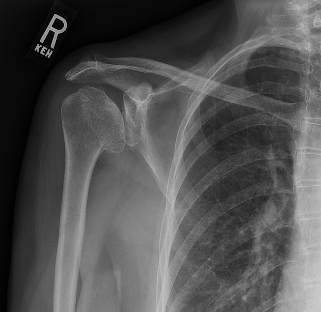 Thiểu sản ổ chảo (Glenoid hypoplasia)