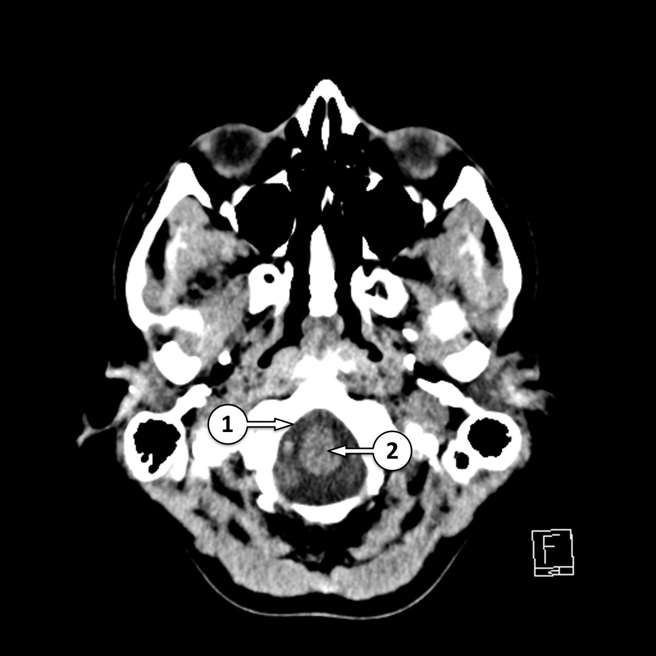 CT não không thuốc