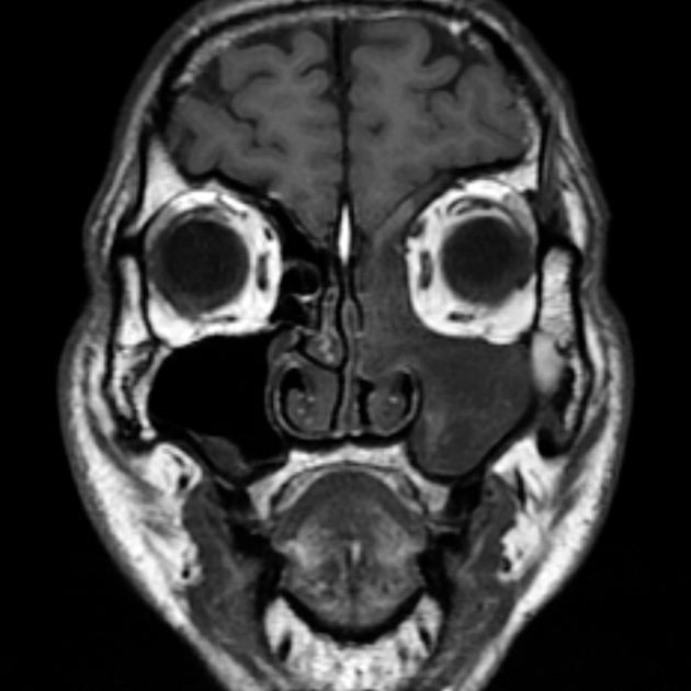U nhú lộn ngược mũi xoang (Inverted papillomas)