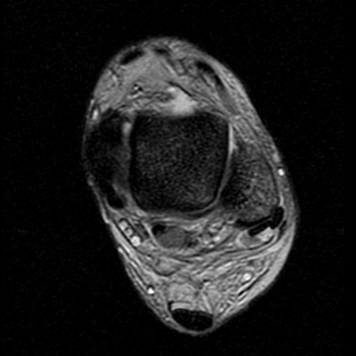 Tổn thương mạc giữ gân mác trên (Superior peroneal retinaculum injuries) 