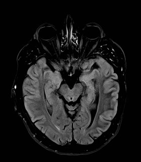 Co giật do tăng đường huyết không nhiễm toan ceton (Non-ketotic hyperglycemic seizures)