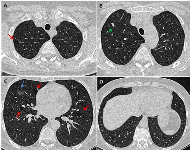 Hội chứng Sjögren (Biểu hiện ở ngực) - Sjögren syndrome (thoracic manifestations)