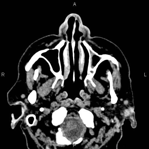 Sarcoidosis mắt - Sarcoidosis (orbital manifestations)