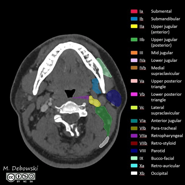 Hạch di căn vùng cổ (Cervical lymph node metastasis)