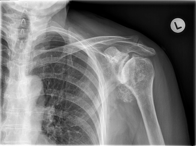 Bệnh lắng đọng Calci Apatite (Hydroxyapatite deposition disease)/Bệnh lý vai Milwaukee (Milwaukee shoulder)