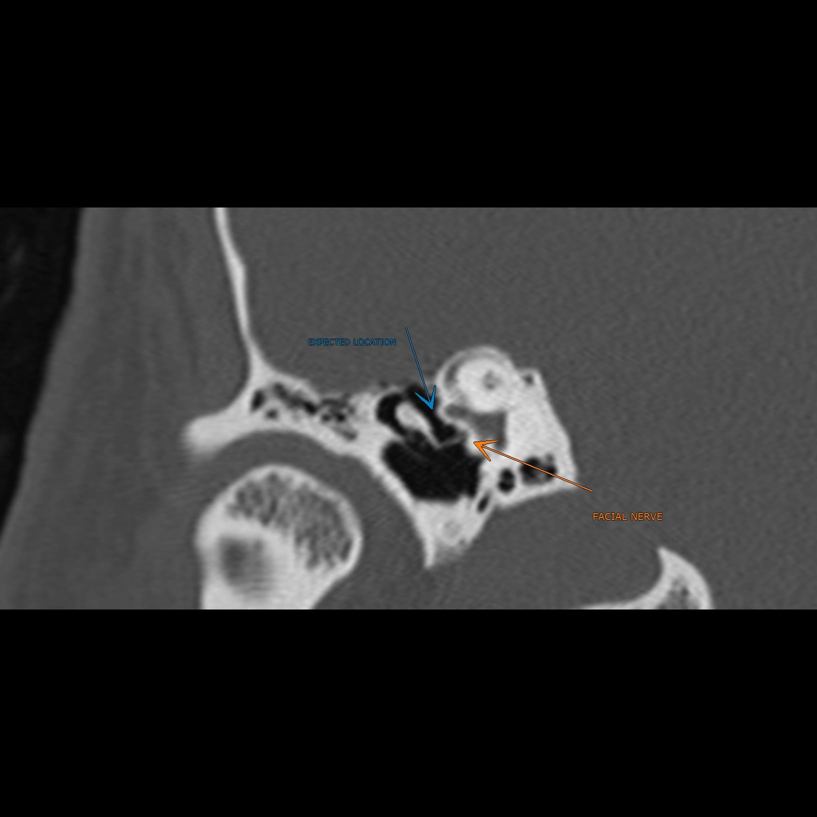 Tịt cửa sổ bầu dục (Oval window atresia)