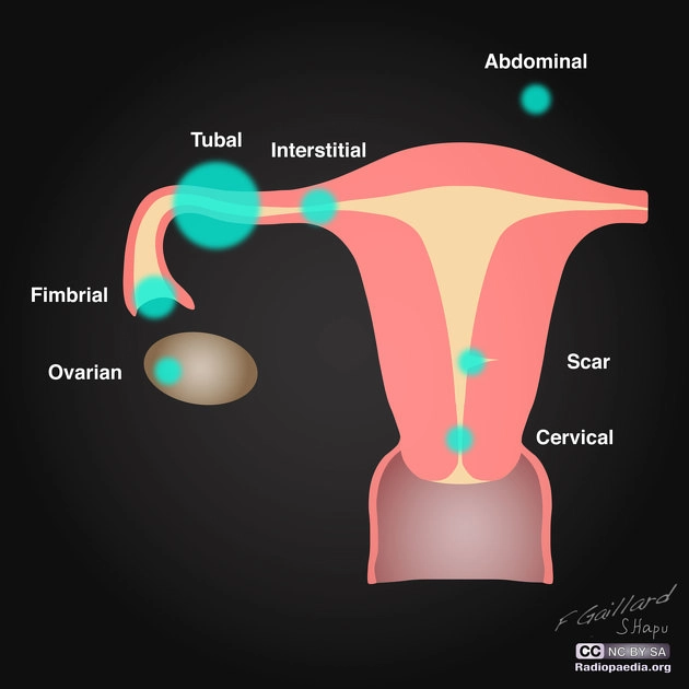Thai ngoài tử cung đoạn vòi (Tubal ectopic pregnancy)