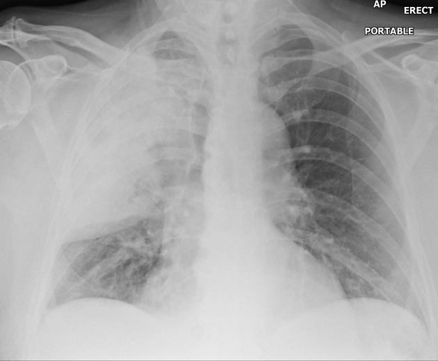 Xoắn phổi (Lung torsion)