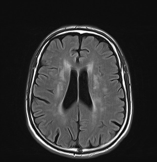  Biến chứng của xạ trị sọ (Complications of cranial radiation therapy) 