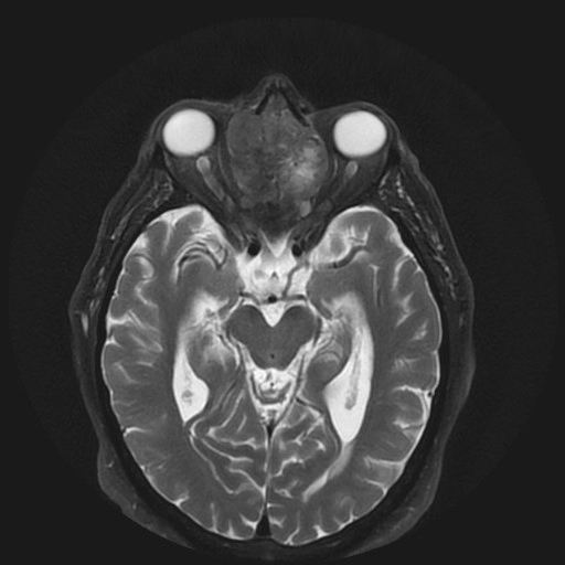 Ung thư biểu mô tuyến mũi xoang (Sinonasal adenocarcinomas)