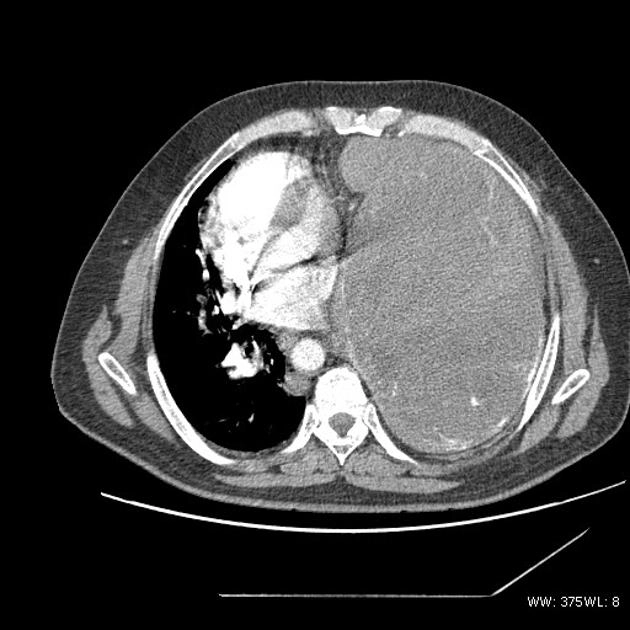 U sợi đơn độc (Solitary fibrous tumor)