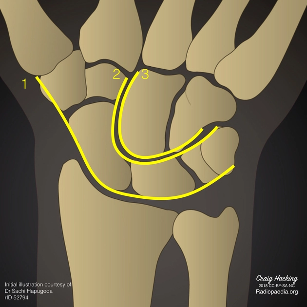 Ba cung cổ tay của Gilula (Gilula's three carpal arcs)