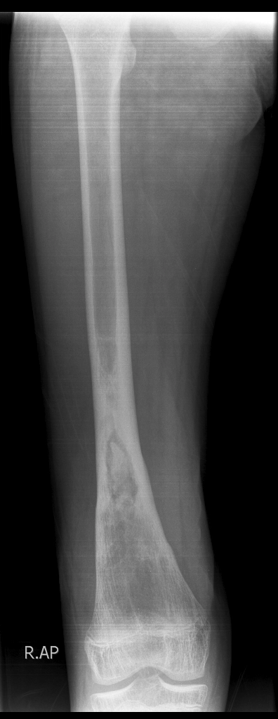 Viêm xương tủy mạn tính (Chronic osteomyelitis)