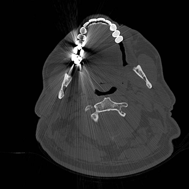 Nút sừng ống tai ngoài (Keratosis obturans)