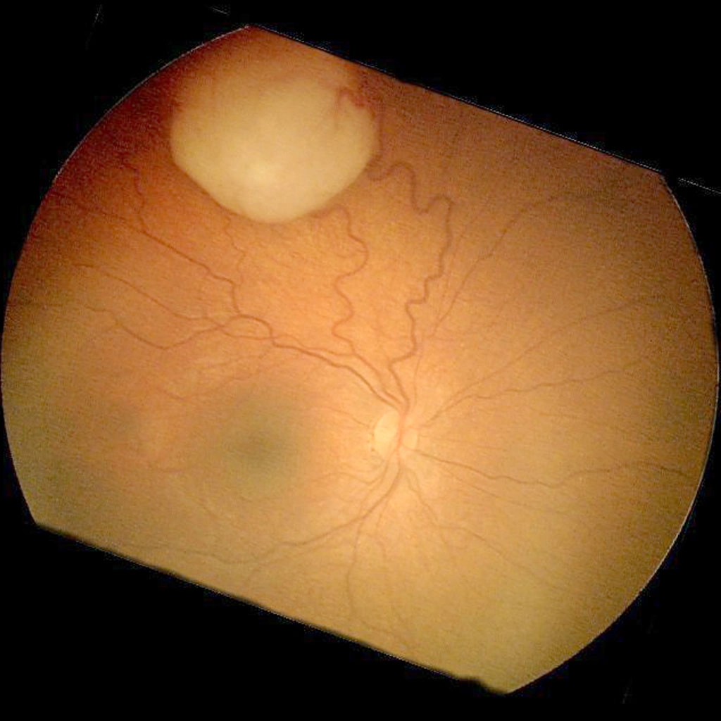 U nguyên bào võng mạc (Retinoblastomas)