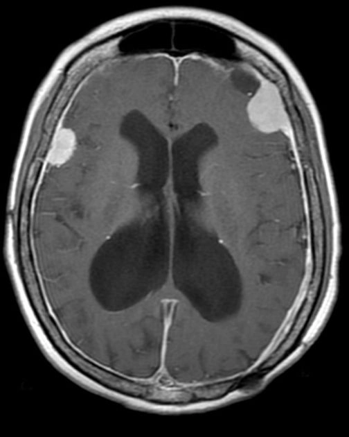 U màng não do xạ trị (Radiation-induced meningiomas)