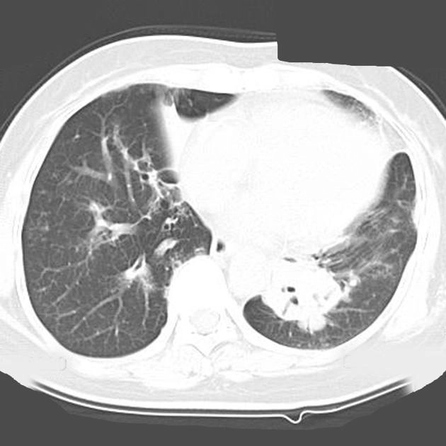 U Lymphoma phổi (Pulmonary lymphoma - PL)