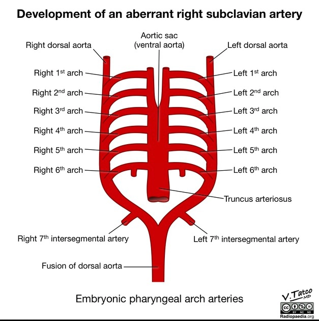 Động mạch dưới đòn phải lạc chỗ (Aberrant right subclavian artery)