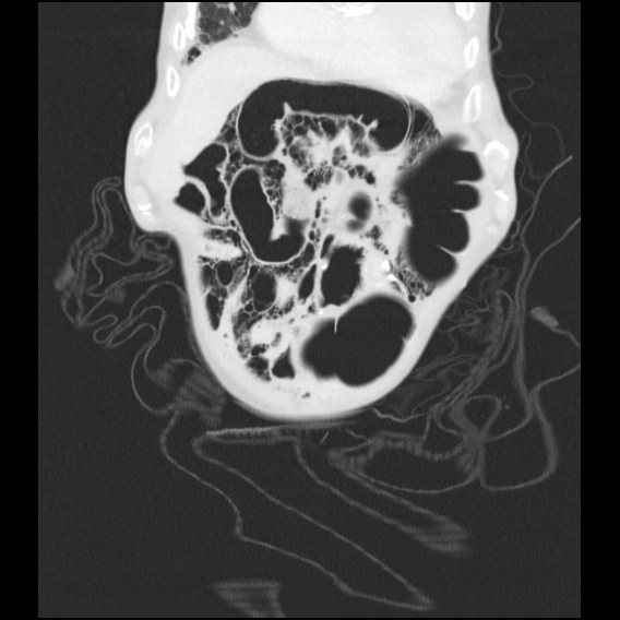 Bóng khí trong thành ruột (Pneumatosis cystoides intestinalis)