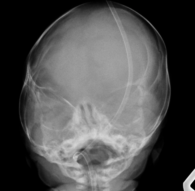 Dính khớp sọ (Craniosynostosis)