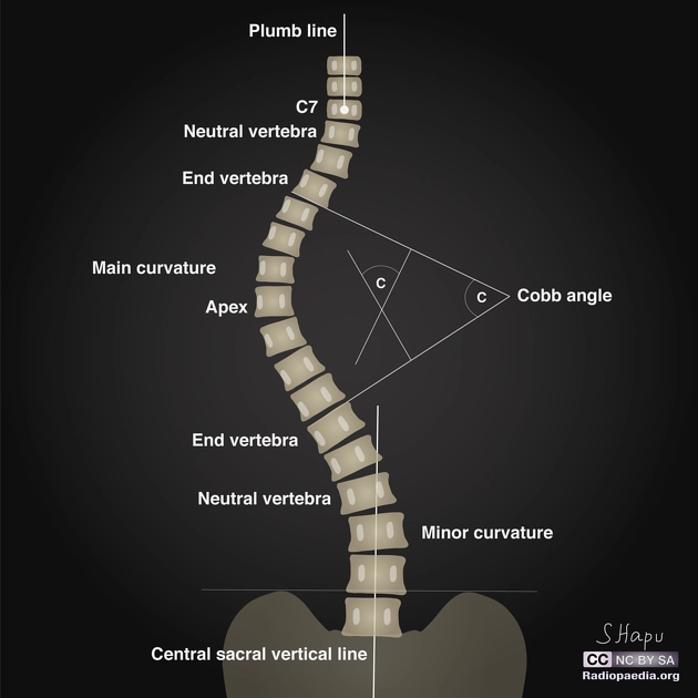 Vẹo cột sống (Scoliosis)