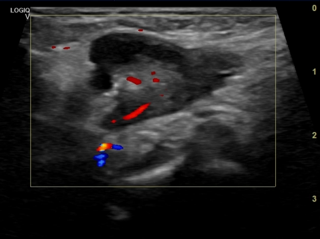 Thoát vị ống Nuck (Canal of Nuck hernia)