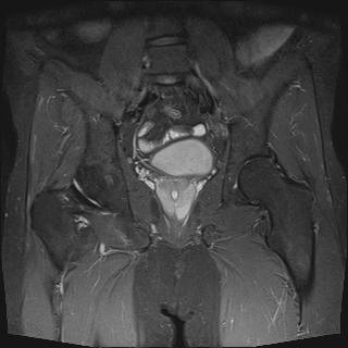 Nang ống Muller (Müllerian duct cyst)