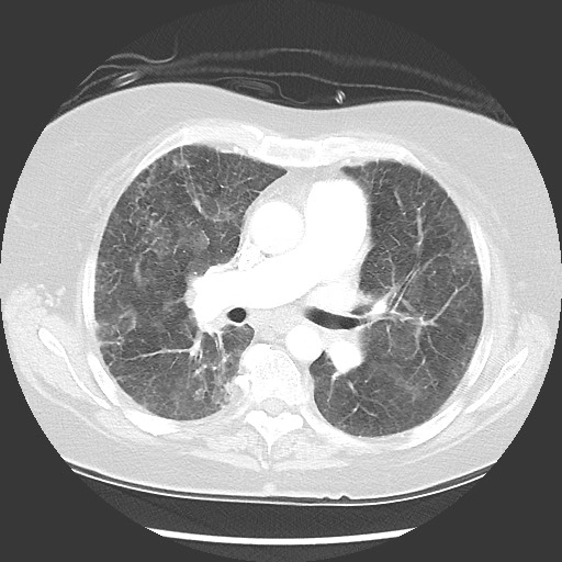Tắc nghẽn tĩnh mạch phổi (Pulmonary veno-occlusive disease - PVOD)/ Bệnh u máumao mạch phổi (Pulmonary capillary hemangiomatosis -PCH)